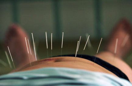 Tratamentul cu acupunctura a bolilor sistemului respirator