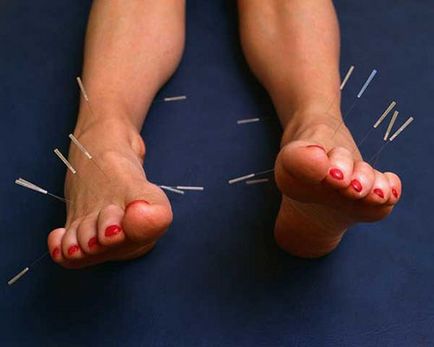 Acupunctura este o procedura populara ♡