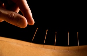 Acupunctura in cazul unei hernie a coloanei vertebrale