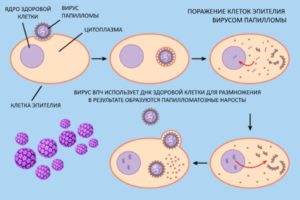 Imunomodulatoarele cu HPV - cât de eficientă este utilizarea
