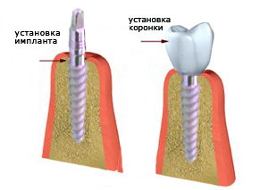 Implantation, vita sens - clinica stomatologică din Yakutsk