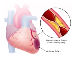 Infarctul miocardic