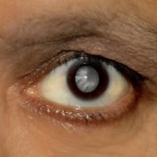 Lentila artificiala a ochiului - viata de serviciu, tipurile de lentile artificiale, avantajele acestora si