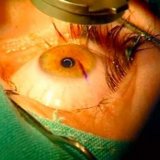 Lentilă artificială, operații cu lentilă - bisturiu - medical