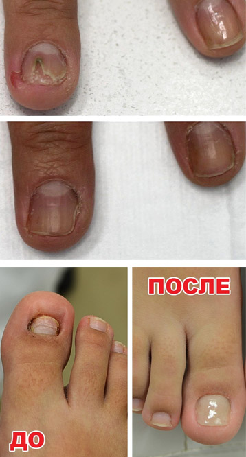tratament cu iodinol ciuperca unghiilor)