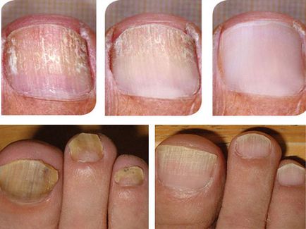 tratament ciuperca unghiilor forma avansata cu iodinol