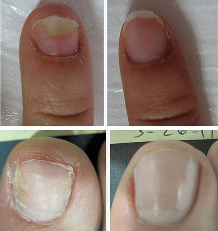Cum se tratează ciuperca unghiilor cu Iodinol - Papiloame September