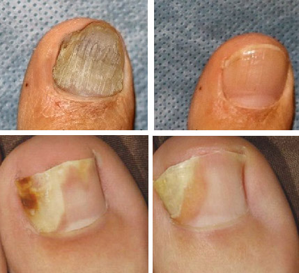 iodinol a nail fungus alkalmazásból