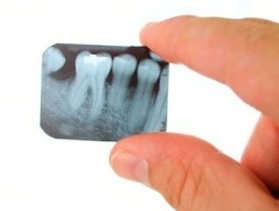Як робити рентген-знімок зуба правильно, щоб і результат порадував і здоров'ю не нашкодити