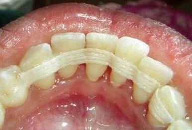 Hogyan kell kezelni a fogágy antibiotikumok vektor gép, lézeres