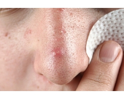 Cum să scapi de acnee pe nas