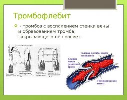 Як лікувати тромбофлебіт поради та рекомендації, uflebologa