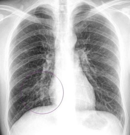 Cum se distinge bronșita de pneumonie, simptomatologie, diagnostic