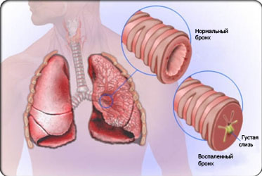 Cum se distinge bronșita de pneumonie, simptomatologie, diagnostic