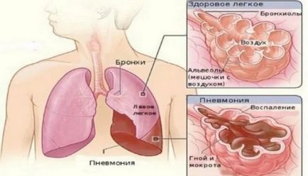 Cum se distinge bronșita de pneumonie, simptomatologie, diagnostic