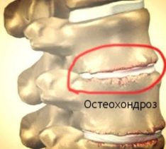 Medicul care tratează osteochondroza coloanei vertebrale și la care specialistul trebuie să contacteze