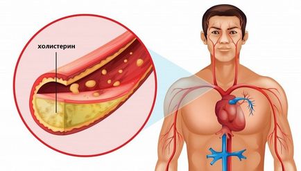 Cum sa scadem colesterolul si medicamentele care reduc colesterolul, ce si cum