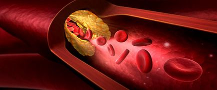 Cum sa scadem colesterolul si medicamentele care reduc colesterolul, ce si cum