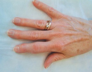 Hogyan lehet megelőzni a fejlesztés arthritis a kezek