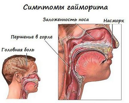 Cum să recunoașteți semnele sinusite, simptomele, catarla, tratamentul, adenoidele, inhalările, cauzele