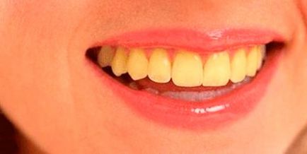 Cum se face dintii mai albi in Photoshop si straluceste cu un zâmbet alb zăpadă