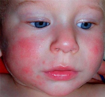 Як виглядає алергія у дитини, фото алергії, причини і симптоми