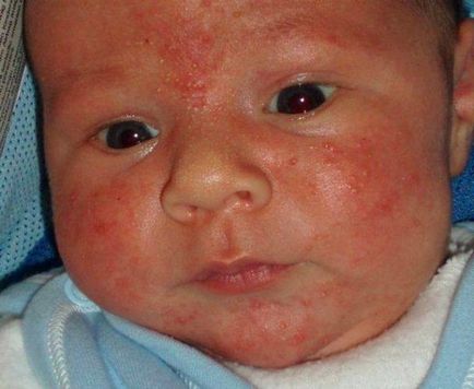 Cum arată alergia copilului, fotografii alergice, cauze și simptome