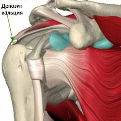 КАЛЬЦИНУЮЧА тендиніт плеча, центр Дикуля