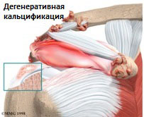 Calcinarea tendonită a umărului, centrul pula