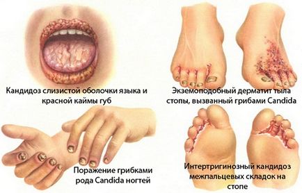 Каприлова кислота молочниця у жінок, чоловіків-лікування кандидозу кишечника, вагінального, порожнини