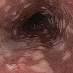 Kaprilsav szájpenész nőknél, kezelésére férfiaknál bél candidiasis, vaginális, orális (szájpenész) Kaprilsav szájpenész nőknél, kezelésére férfiaknál bél candidiasis, vaginális, orális