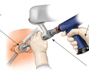 Hip Cyst - opțiuni de tratament