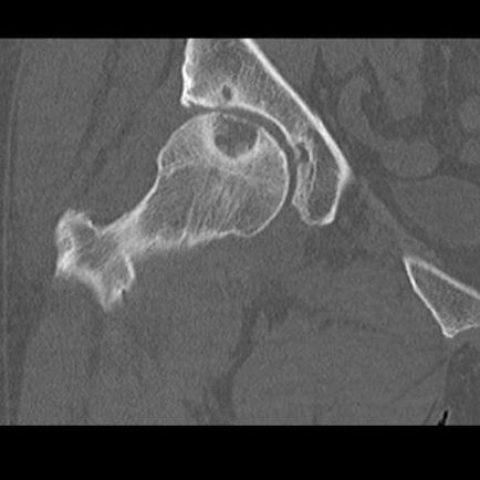 Hip Cyst - opțiuni de tratament