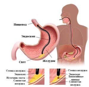 Кіста холедоха у дітей симптоми, діагностика, лікування, ускладнення