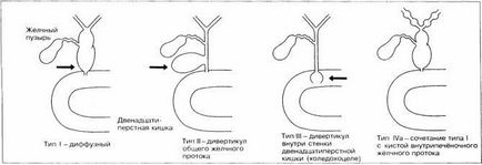 Кіста холедоха у дітей симптоми, діагностика, лікування, ускладнення