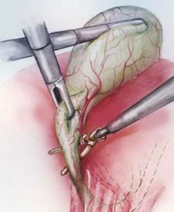 Chistul Choledocha la copii simptome, diagnostic, tratament, complicații