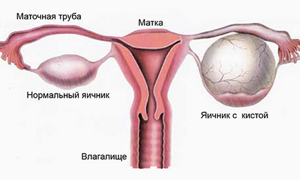 Кіста жовтого тіла яєчника симптоми і лікування