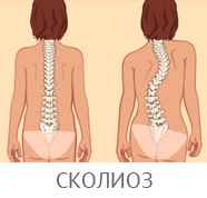 Manifestările clinice ale osteocondrozei coloanei vertebrale, cum se manifestă semnele inițiale