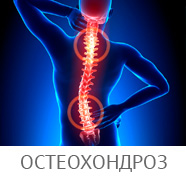 Клінічні прояви остеохондрозу хребта, як проявляються початкові ознаки