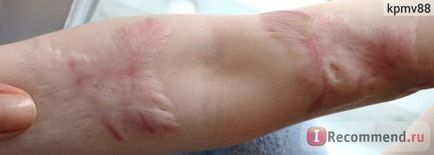 Tricotajele de compresie sunt active active anti-cicatrizare lenjerie de corp - 