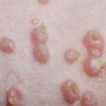 Molluscum contagiosum la copii - fotografie (pe față, pe corp), tratament în stadiul inițial