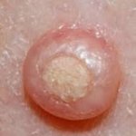 Molluscum contagiosum la copii - fotografie (pe față, pe corp), tratament în stadiul inițial