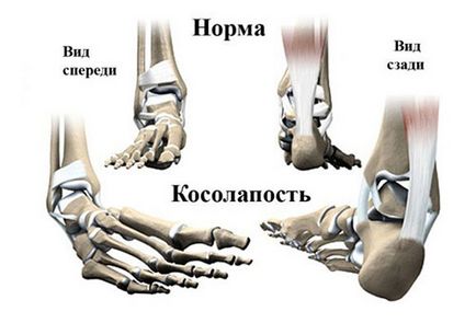 Kozolapie la copii - tratament, cauze și prevenire