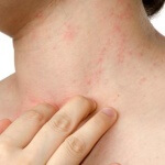 Viszkető bőr, allergia, gyulladás, akár prednizolon segít