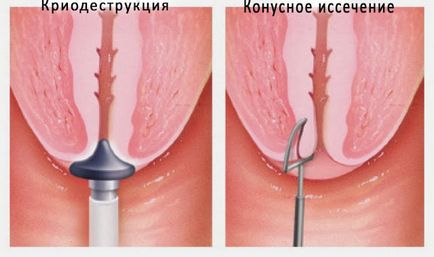 Crioterapia cervicală 5 fapte despre procedură