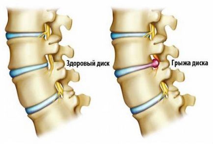 Cine tratează osteocondroza pe care medicul o implică în această boală a coloanei vertebrale