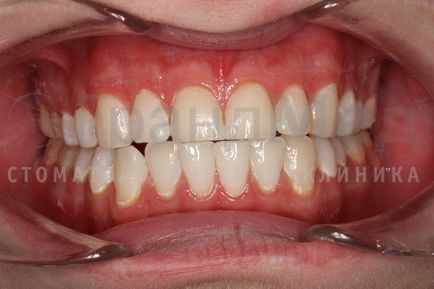 Лазерне відбілювання зубів в спб - ціна на лазерне відбілювання, відгуки про процедуру