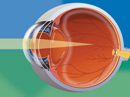 Rövidlátás kezelésére (Szemmikrosebészet) myopia kezelésére