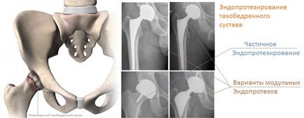 Tratamentul endoproteticilor articulațiilor de șold în clinici din orașul St. Petersburg, prețuri, recenzii