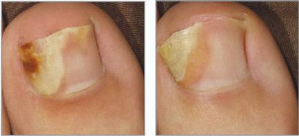 Лікування грибка нігтів йодом різні способи і рецепти